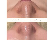 エース(Private Salon ace)の雰囲気（毛穴のバキュームも大人気オプションメニューです！脱いちご鼻）