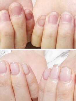 ラウラージュ(Raurage)の写真/【美爪自爪育成】爪が小さい/薄い/弱い/改善しない癖がある等爪の悩みに特化した施術をします◎