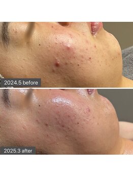 ロッタ エクリュ(Lotta ecru+)/REVI剥けないハーブピーリング