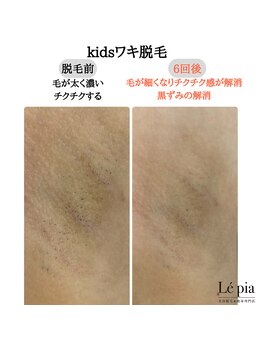 レピア(Le'pia)/kidsも◎ムダ毛とサヨナラ♪