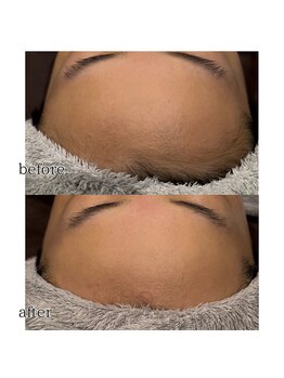 アデル 久留米(ADEL)/フェイシャルワックス《額》