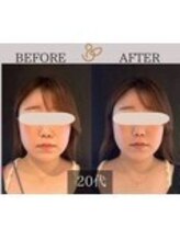チョコバリ 中目黒店(chocobari)/小顔×リフトアップ(美容鍼)20代