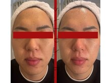 ダーマグロウ小顔造形コース【初回\22,000】小顔/レッドショット