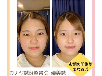 カナヤ鍼灸整骨院/美容鍼ビフォーアフター★