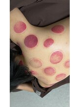 はり灸治療院 えがお/吸玉療法