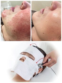 ビエル(Bielle)の写真/朝起きた瞬間、鏡を見るのが怖い《皮膚科提携》赤み不安定肌、気になる跡の根本改善フェイシャル