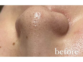 リリーブー 池袋(Lilyboo)/毛穴洗浄ハイドラフェイシャル