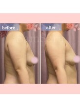 サムサラ(SamSara)/BeforeAfter/下垂/バストアップ