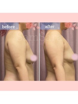 サムサラ(SamSara)/BeforeAfter/下垂/バストアップ