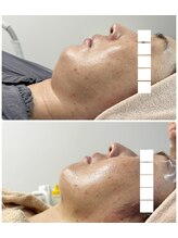 アロラヴィ(AroRavi)/サーマトリックス