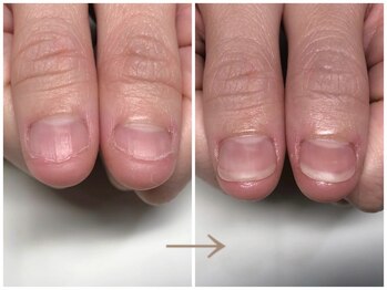 深爪矯正 自爪風