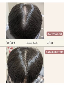 スカルプラボ 倉敷店(Scalp Lab)/moumitu2ヶ月症例