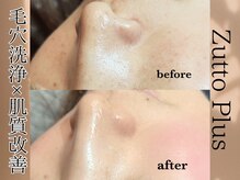 【毛穴洗浄×エアバリ】で魔法レベルのビフォーアフター☆