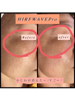 ティアメディカル(Tia Medical)/HIRFWAVEPro