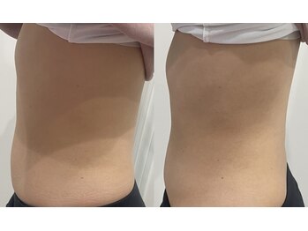 ルナート(Lunart)/腸もみの一回の変化