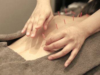 リソラ(RESORA)の写真/【心と体の癒しを求めているあなたへ】大人気！オイル×鍼の組み合わせで心身のバランスを整えませんか？