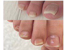 シーネイル(C Nail)/軽い巻き爪なら数回できれいに◎