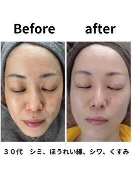 ギンザ リボーン(Ginza Reborn)/シミ、くすみ、ほうれい線