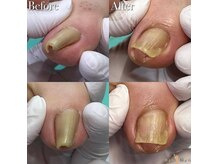 巻き爪補正店 大分店