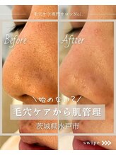 ノイ(Noi.)/Before-After