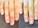 自爪育成・深爪・川崎