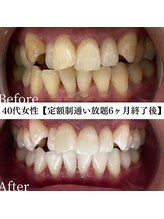 ホワイト 福岡天神店(WHITE)/ホワイトニングビフォーアフター