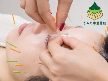 もみの木鍼灸整骨院 恵比寿/初めてでも丁寧の美容鍼