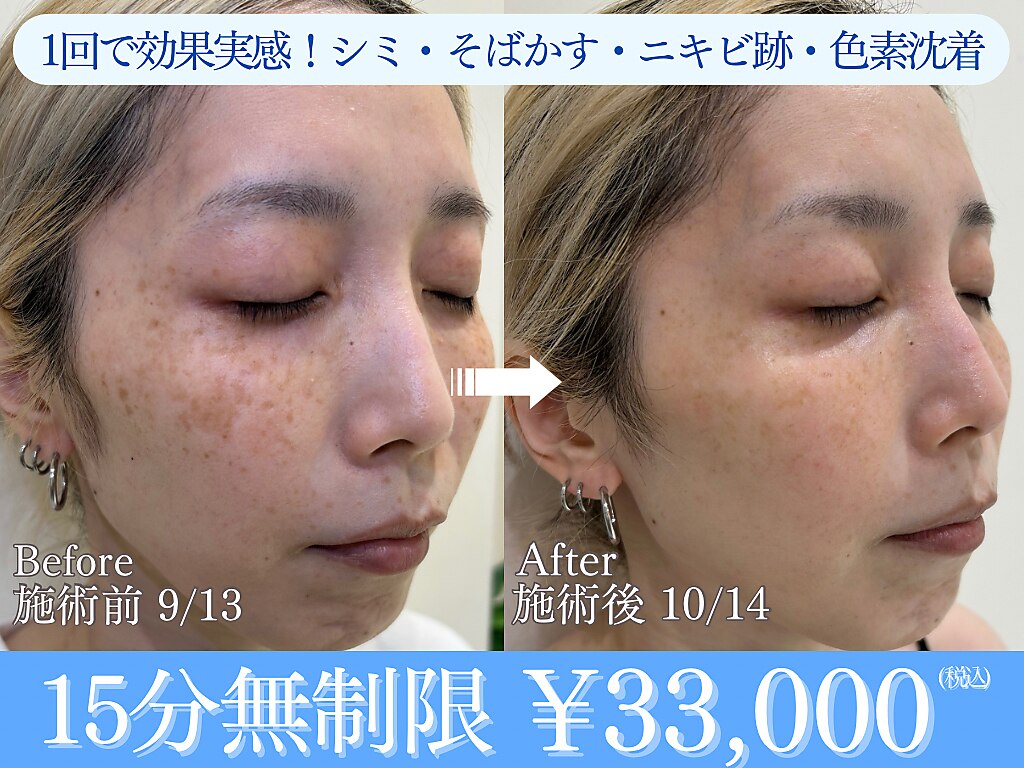 恵比寿駅でエレクトロポレーションが人気のエステサロン