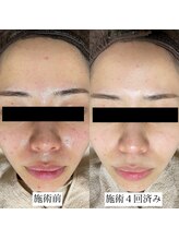 ハル(Halu)/繰り返す芯のあるニキビが軽減