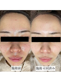 ハル(Halu)/繰り返す芯のあるニキビが軽減