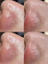 アトリーチェ ベレッツァ(ATTRICE Bellezza)/毛穴洗浄×マーメイド