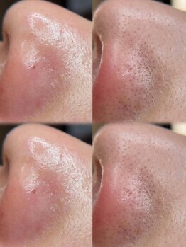 アトリーチェ ベレッツァ(ATTRICE Bellezza)/毛穴洗浄×マーメイド