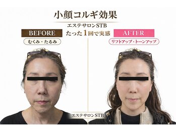 STBの写真/小顔コルギ×ヘッド×モデリングパックで速攻小顔へ。専門スタッフ施術で理想のフェイスラインを実現
