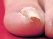 ユーネイル(U.nail)/巻き爪矯正/before