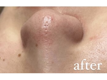 リリーブー 池袋(Lilyboo)/毛穴洗浄ハイドラフェイシャル