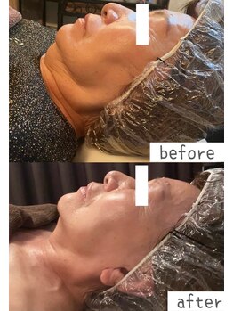 トモズサロン28(Tomos.salon.)/フェイスラインのもたつき改善！