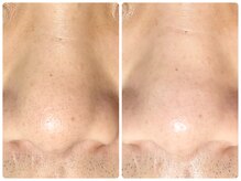 ラウン 京都(ROUN')/ EIEN1回の施術ビフォーアフター