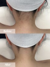 アップユー(UPU)/うなじ　ビフォーアフター