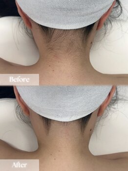 アップユー(UPU)/うなじ ビフォーアフター