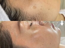 サロンドシエル カスガイ(Salon de Ciel kasugai)/結果重視のシミケア