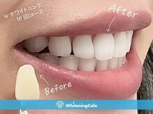 ホワイトニングカフェ赤羽店/ホワイトニングビフォーアフター