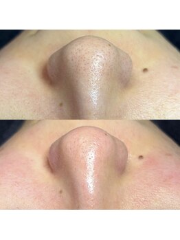 スピカ(Spica)/毛穴エクストラクション