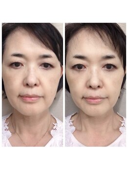 たけみや/光美肌フェイシャル