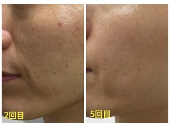 ファームディ(Pharm.D)/シミに悩む方へ