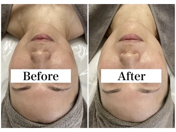 ホリシア 博多(HORISHIA)/ハーブピーリング/ニキビケア