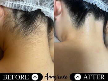 アングレイス(Anngrace)/【お顔脱毛うなじ】Before/After