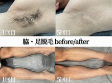シャイン 佐賀店(SHINE)/脇・足脱毛ビフォーアフター