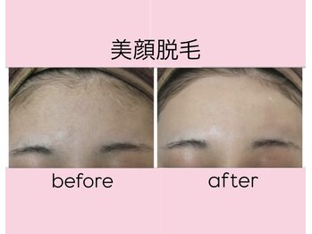 エステティック　レイビス 渋谷店(RAYVIS)/仕上りの良さが自慢の美肌脱毛