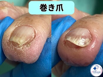 プラスワンフット 本厚木(+1 Foot)/巻き爪矯正は専門店へ●