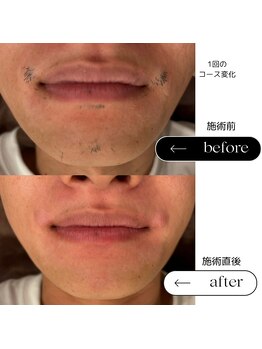 エスト(Est_.)/美容電気脱毛【レーザー残り毛】